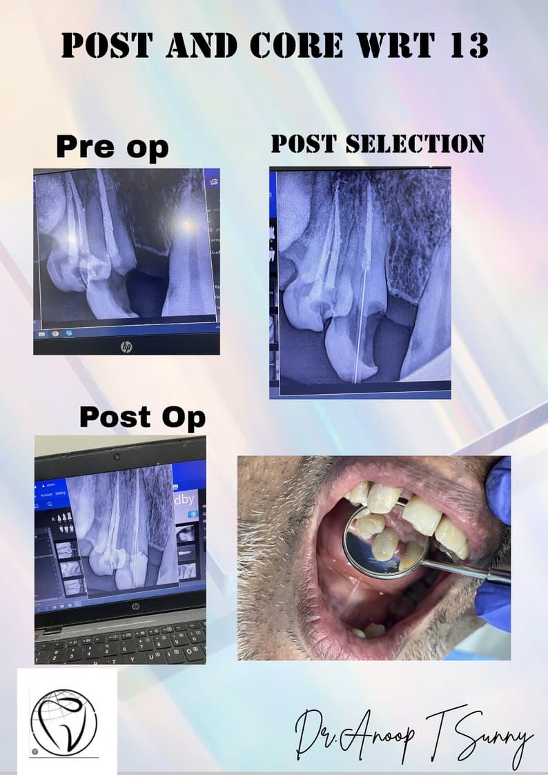 Post & Core Build-Up