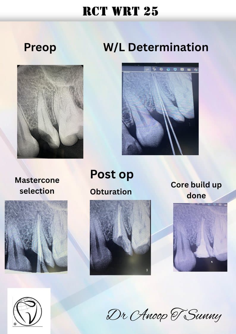 RCT — Root Canal Treatment