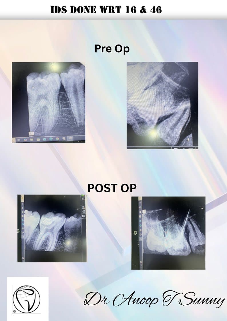 Indirect Restoration (IDS)