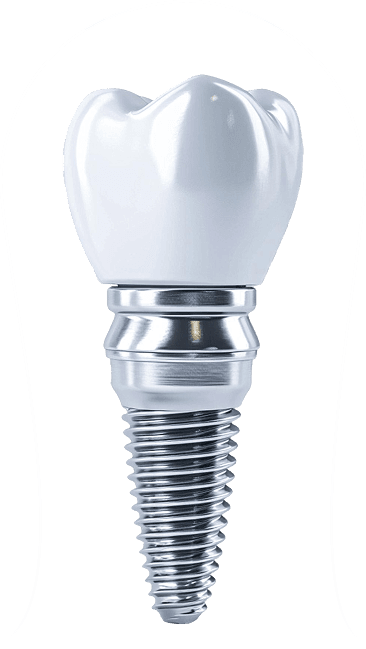 Dental implant illustration